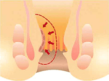 脱出や肛門のまわりの腫れを改善